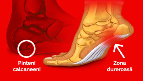 Pinteni calcaneeni