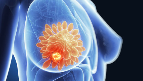 Despre cancerul mamar – informații utile pentru paciente