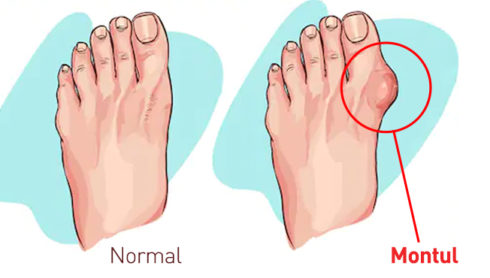 MONTURILE (HALLUX VALGUS )